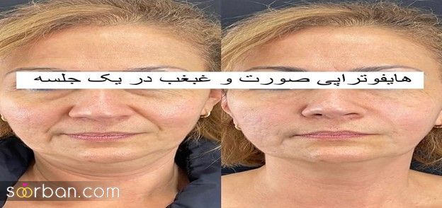 روش‎های مختلف جوانسازی صورت