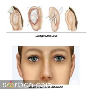  جراحی زیبایی گوش (اتوپلاستی) توسط دکتر اسلامی جو 