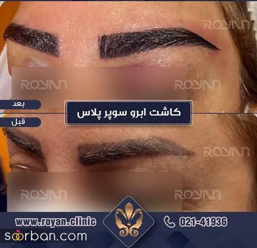 کاشت ابروی طبیعی چیست و چقدر هزینه دارد ؟