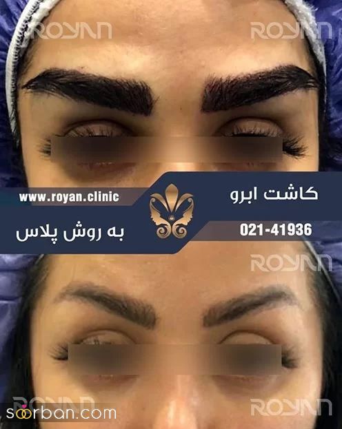 کاشت ابروی طبیعی چیست و چقدر هزینه دارد ؟