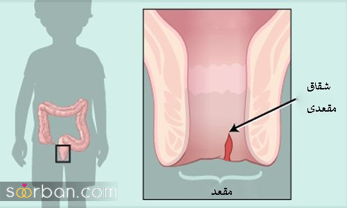 انواع روش های درمان شقاق (لیزر، جراحی و خانگی)