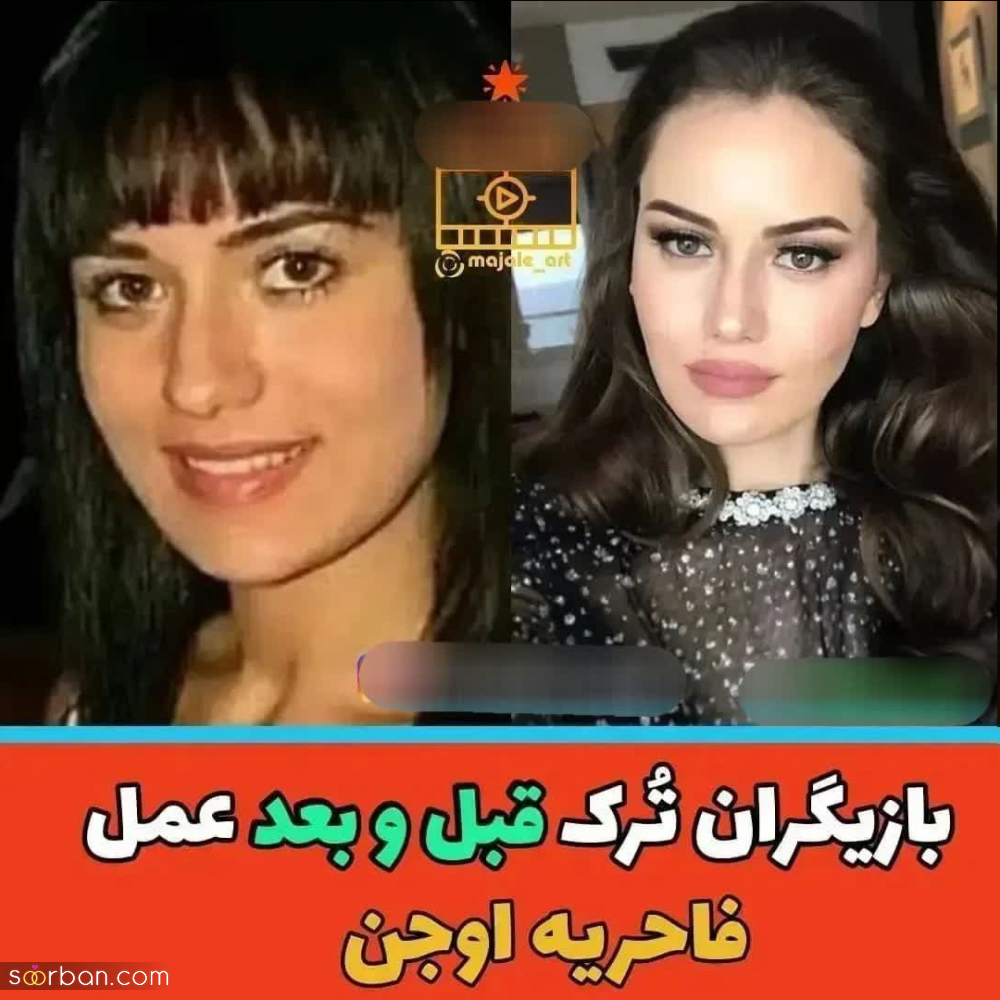 چهره بازیگران مطرح ترکیه ای قبل و بعد از عمل های متعدد زیبایی از هانده ارچل تا دمت اوزدمیر