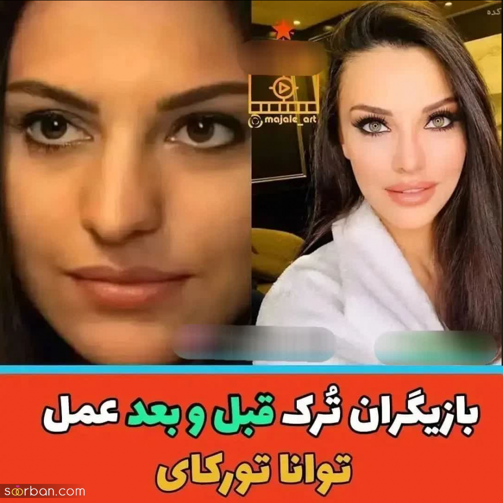 چهره بازیگران مطرح ترکیه ای قبل و بعد از عمل های متعدد زیبایی از هانده ارچل تا دمت اوزدمیر