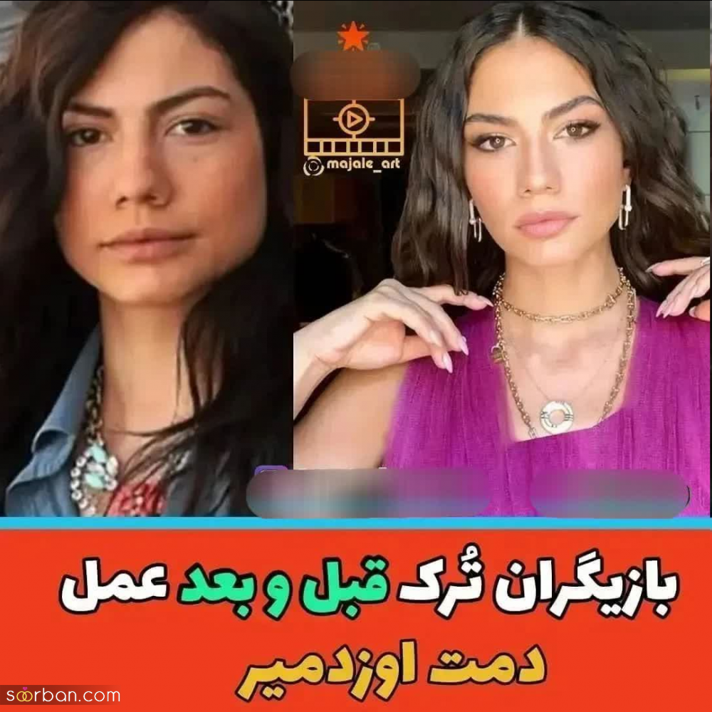 چهره بازیگران مطرح ترکیه ای قبل و بعد از عمل های متعدد زیبایی از هانده ارچل تا دمت اوزدمیر