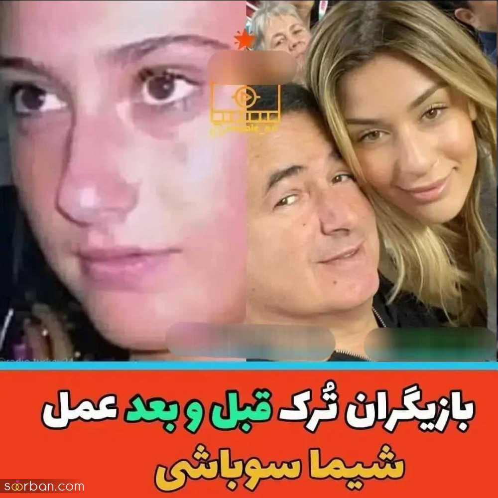 چهره بازیگران مطرح ترکیه ای قبل و بعد از عمل های متعدد زیبایی از هانده ارچل تا دمت اوزدمیر