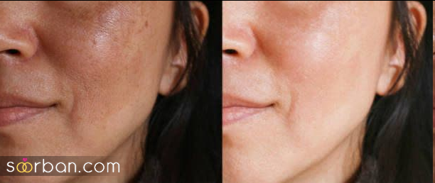 درمان قطعی ، اصولی و بدون بازگشت منافذ باز پوست صورت در هر نوع تایپ پوستی!