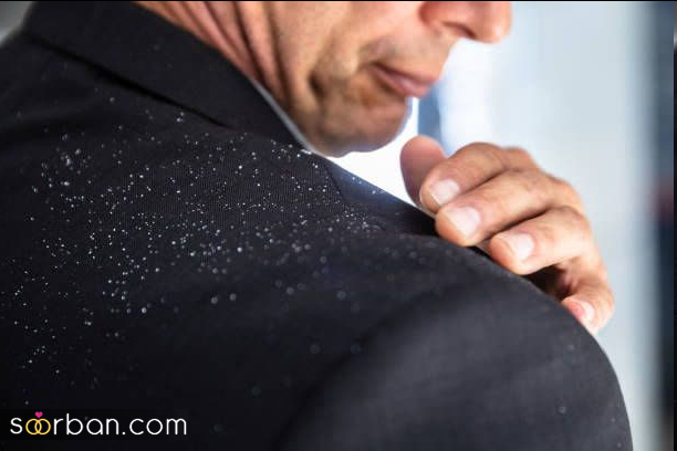 با این 10 راهکار ساده و ارزان از شر شوره سر خلاص شو!