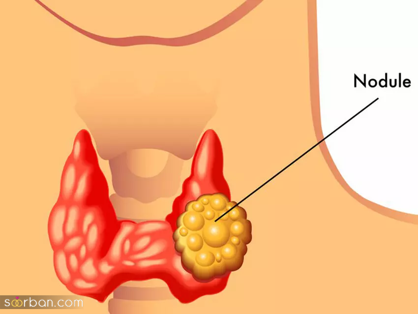 درمان ندول تیروئید با سیاه ‌دانه از شایعه تا واقعیت 