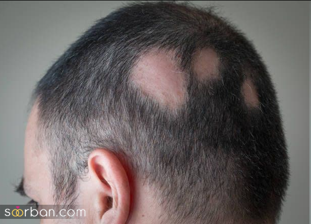 چرا موهات میریزه؟ 10 علت اصلی ریزش مو را بدانید!