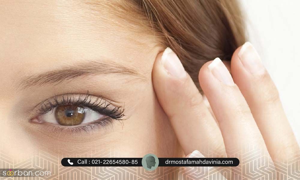  لیفت دور چشم با نخ خطر دارد ؟