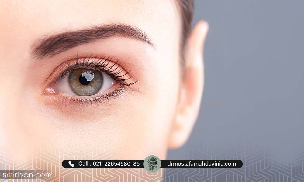مزایا و معایب لیفت دور چشم با نخ