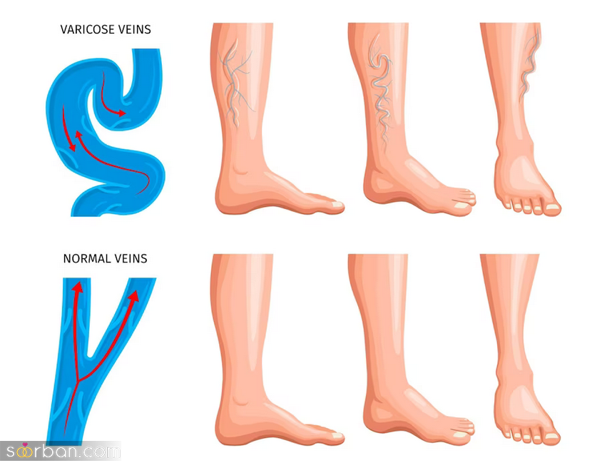 درمان واریس پا با دکتر هومان کاظمی