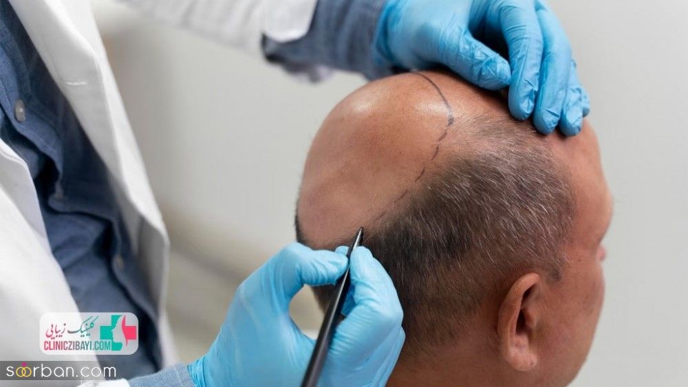 شرایط و مراحل انجام کاشت تخصصی مو در شیراز و سایر شهرستان ها
