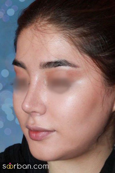 عوارض خندیدن بعد از عمل بینی؛ نحوه خندیدن بعد عمل بینی چگونه است؟