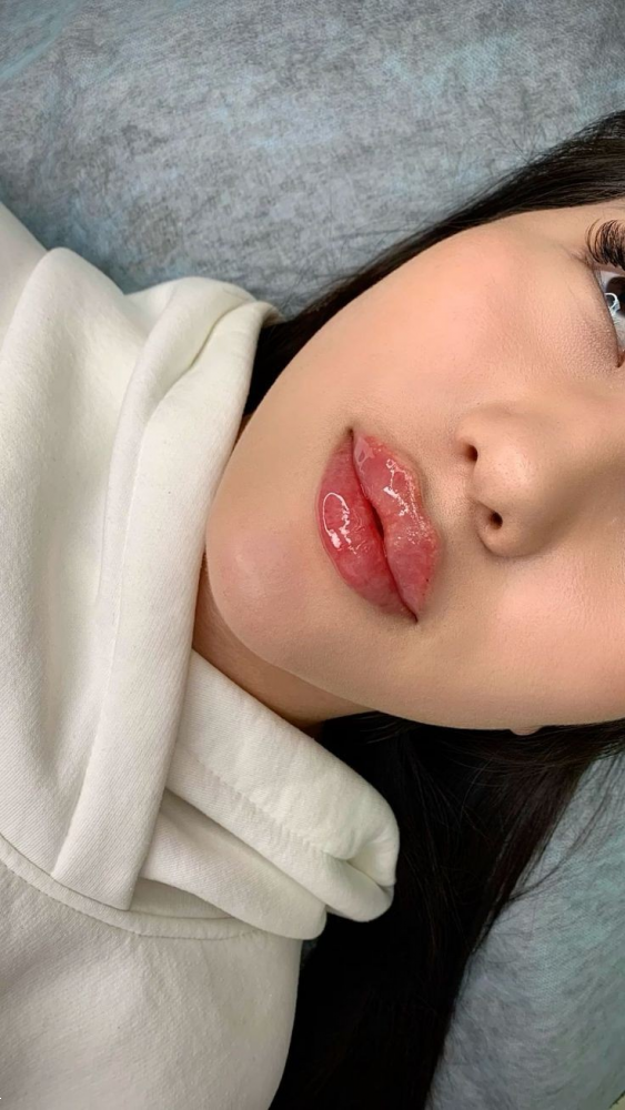 مدل لب روسی | ۲۵ مدل جدید لب روسی ۲۰۲۵ برای داشتن لب‌های عروسکی و قلوه‌ای + نکات طلایی قبل و بعد از تزریق ژل!