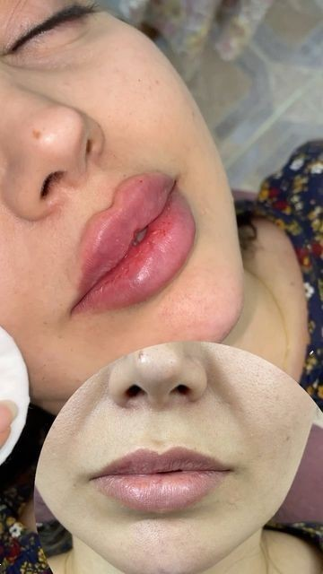 مدل لب روسی | ۲۵ مدل جدید لب روسی ۲۰۲۵ برای داشتن لب‌های عروسکی و قلوه‌ای + نکات طلایی قبل و بعد از تزریق ژل!
