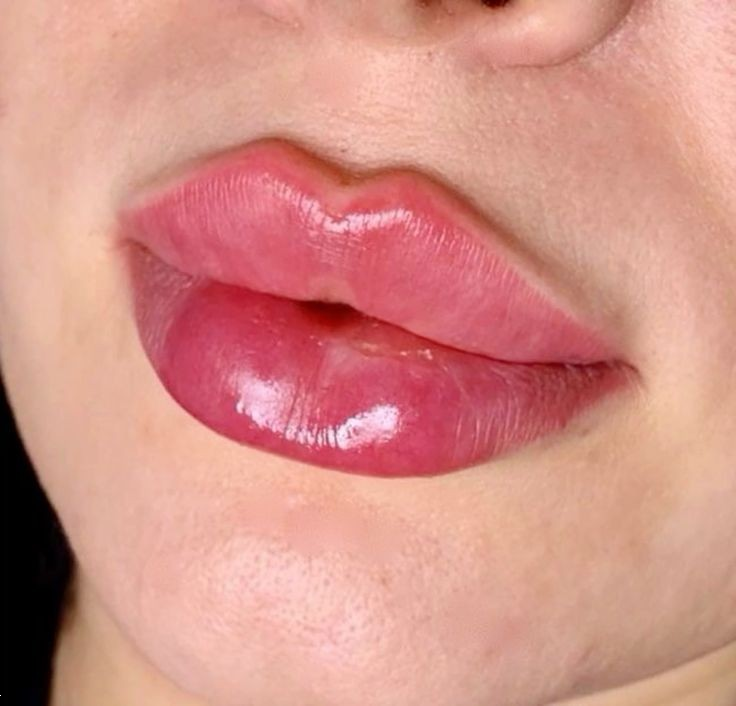 مدل لب روسی | ۲۵ مدل جدید لب روسی ۲۰۲۵ برای داشتن لب‌های عروسکی و قلوه‌ای + نکات طلایی قبل و بعد از تزریق ژل!