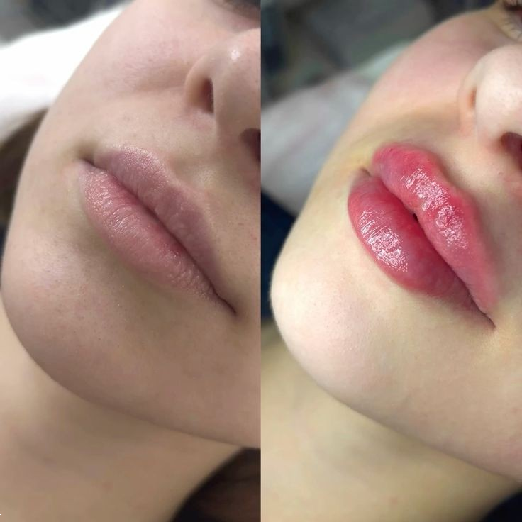 مدل لب روسی | ۲۵ مدل جدید لب روسی ۲۰۲۵ برای داشتن لب‌های عروسکی و قلوه‌ای + نکات طلایی قبل و بعد از تزریق ژل!