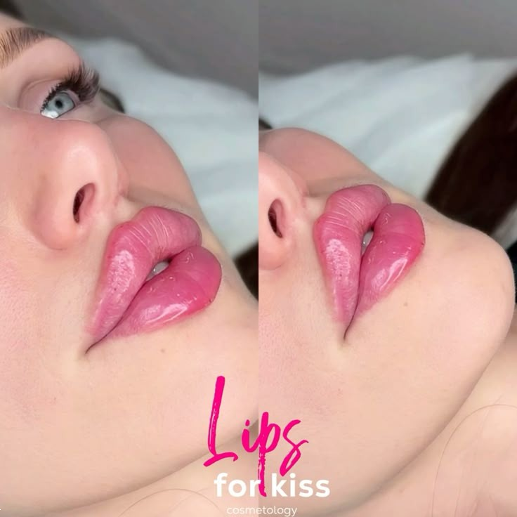 مدل لب روسی | ۲۵ مدل جدید لب روسی ۲۰۲۵ برای داشتن لب‌های عروسکی و قلوه‌ای + نکات طلایی قبل و بعد از تزریق ژل!