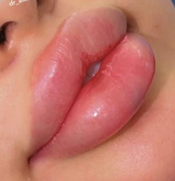 مدل ژل لب | ۱۰ ترند برتر مدل ژل لب ۲۰۲۵؛ کدوم فرم به چهره‌ات میاد؟ (عروسکی، نچرال، روسی و کره‌ای)
