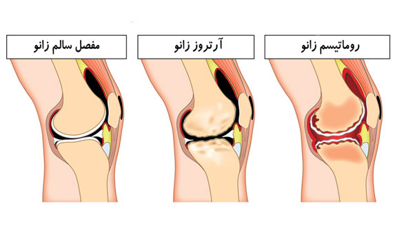 آرتروز زانو و درمانهای بدون جراحی