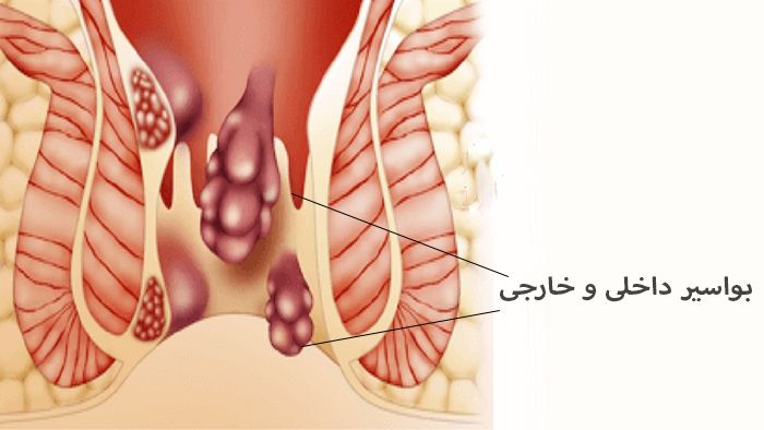 اهمیت انتخاب پزشک در درمان بواسیر یا هموروئید