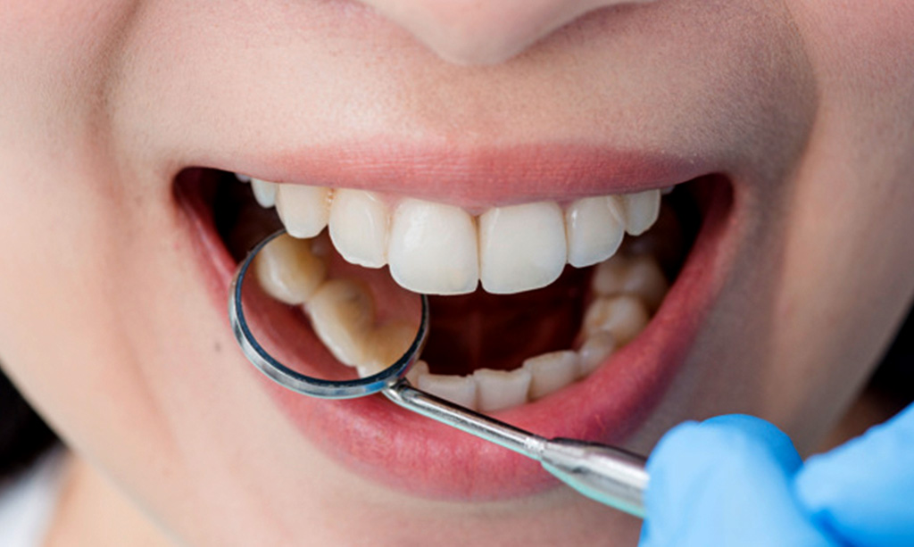 لمینت و بلیچینگ دندان برای چه افرادی توصیه می شود ؟