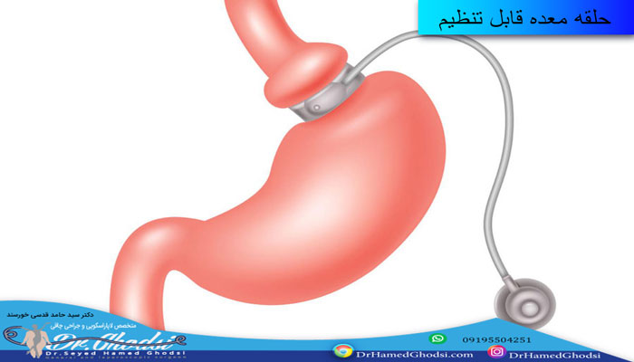 درمان چاقی با استفاده از عمل‌ های جراحی