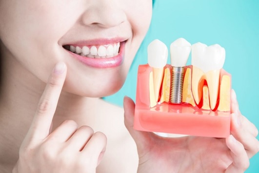 ایمپلنت دندان چیست + روند جراحی ایمپلنت دندان