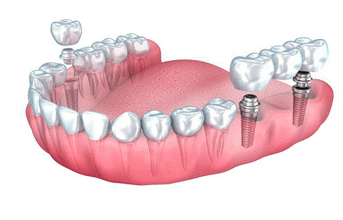 ایمپلنت دندان چیست + روند جراحی ایمپلنت دندان