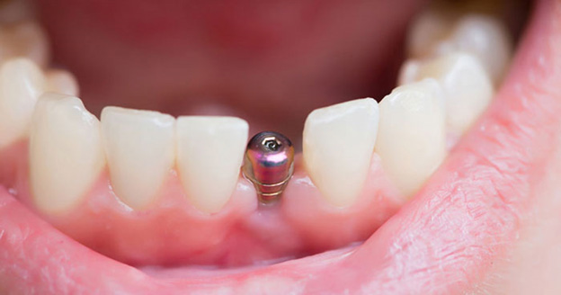 ایمپلنت دندان چیست + روند جراحی ایمپلنت دندان