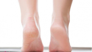 درمان ترک کف پا + درمان سریع و قطعی ترک پا با 11 روش خانگی و راحت