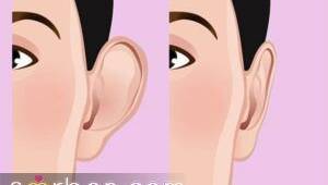  جراحی زیبایی گوش (اتوپلاستی) توسط دکتر اسلامی جو 