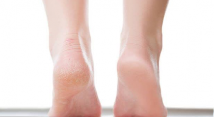 درمان ترک کف پا + درمان سریع و قطعی ترک پا با 11 روش خانگی و راحت
