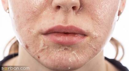 چرا صورتم پوسته پوسته میشه؟ | دلایل و 5 درمان پوسته شدن پوست صورت و بدن